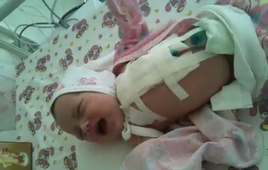 Донецкие хирурги вырезали у младенца опухоль величиной с кулак